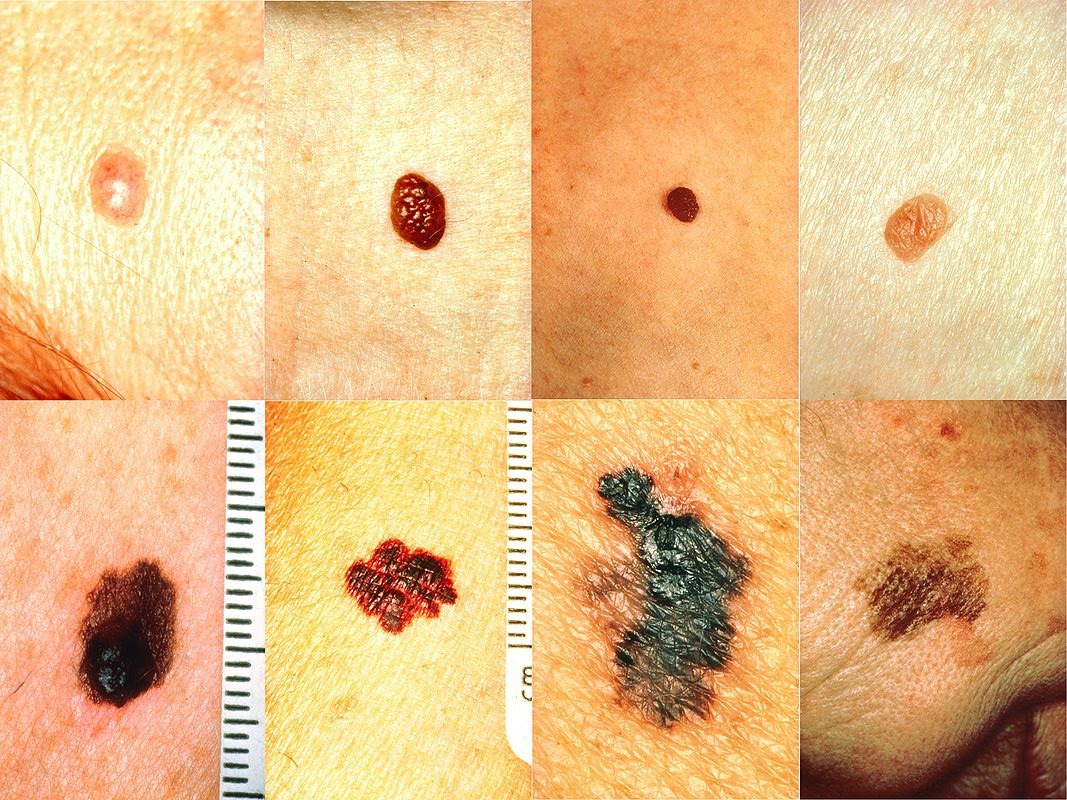 In the lower row from left to right: melanomas showing (A) Asymmetry, (B) a border that is uneven, ragged, or notched, (C) coloring of different shades of brown, black, or tan and (D) diameter that had changed in size. The normal moles in the top row do not have abnormal characteristics (no asymmetry, even border, even color, no change in diameter).<br />—<br />ABCD rule by National Cancer Institute via Skin Cancer Foundation [Public Domain]
