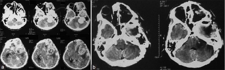 Clinical photographs of the patient (a) before his operation (preoperative CT), and (b) after his operation (postoperative CT). Can you find the tumour?<br />—<br />© 2014 Arifin MZ, from <a href="https://www.ncbi.nlm.nih.gov/pmc/articles/PMC4287917/">Surg Neurol Int. 2014; 5: 174</a>.
